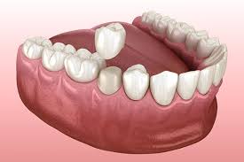 Dental Crown SmileArt Kenya