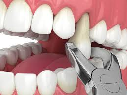 Tooth Extraction SmileArt Kenya