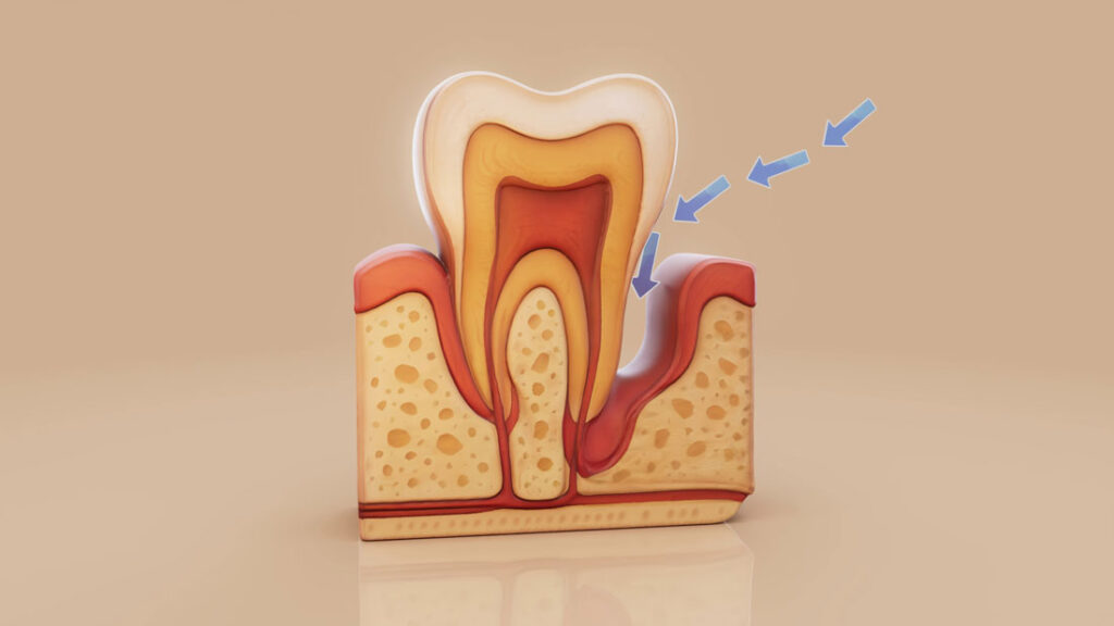 Filling-cavity-SmileArt-Kenya-