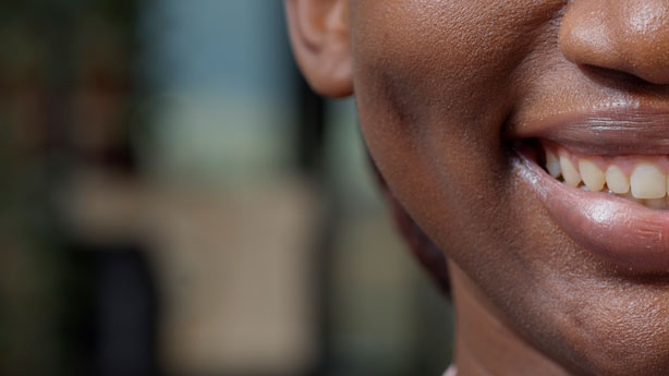 Veneers-SmileArt-Kenya-